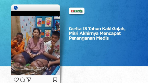 Derita 13 Tahun Kaki Gajah, Misri Akhirnya Mendapat Penanganan Medis